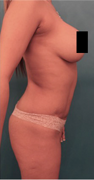 Liposuction Patient #17 Before Photo Thumbnail # 7