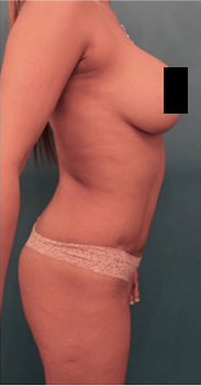 Liposuction Patient #17 Before Photo # 7