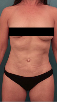 Liposuction Patient #20 After Photo # 2