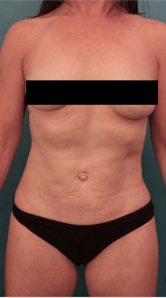 Liposuction Patient