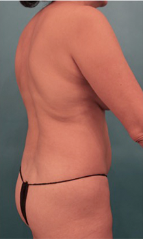 Liposuction Patient #18 Before Photo Thumbnail # 7