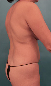 Liposuction Patient #18 Before Photo # 7