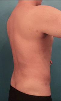 Liposuction Patient #4 After Photo # 6