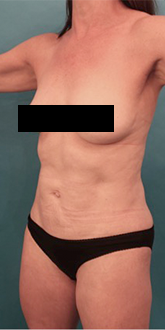 Liposuction Patient #20 After Photo Thumbnail # 4