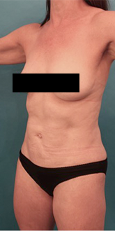 Liposuction Patient #20 After Photo # 4