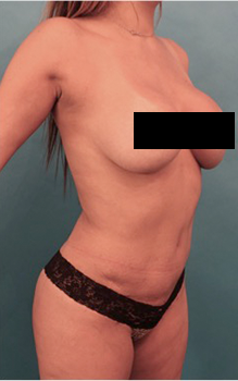 Liposuction Patient #17 After Photo Thumbnail # 10