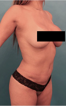 Liposuction Patient #17 After Photo # 10