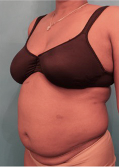 Liposuction Patient #19 Before Photo # 3