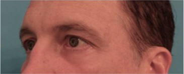 Male Blepharoplasty Patient #1 After Photo # 4