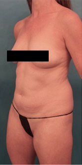 Liposuction Patient #20 Before Photo Thumbnail # 3