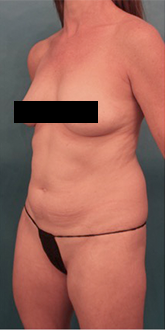 Liposuction Patient #20 Before Photo # 3