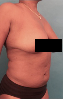 Liposuction Patient #19 After Photo # 8