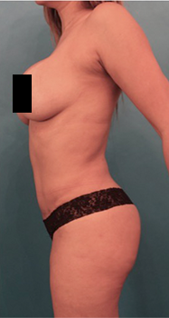 Brazilian Butt Lift Patient #5 After Photo # 2