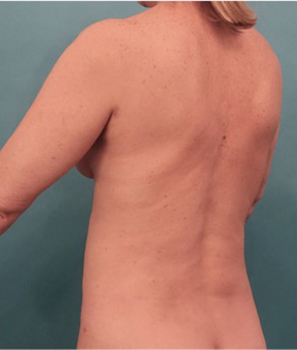 Liposuction Patient #21 After Photo # 8