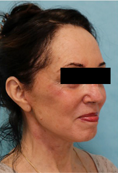 Facelift Patient #3 After Photo # 4