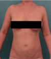 Liposuction Patient #21 After Photo Thumbnail # 2