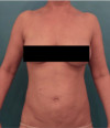 Liposuction Patient