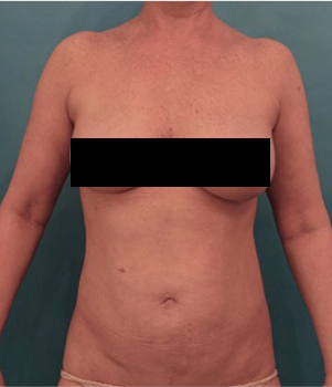 Liposuction Patient #21 After Photo # 2