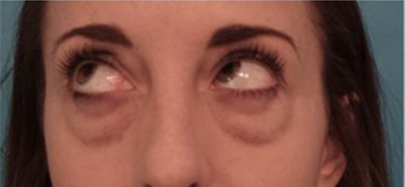Before Image: Lower Eyelid Blepharoplasty Patient #2 - 