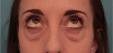 Before Image: Lower Eyelid Blepharoplasty Patient #2 - 