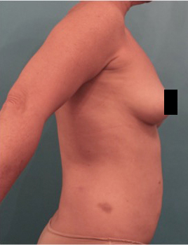 Liposuction Patient #21 Before Photo # 13