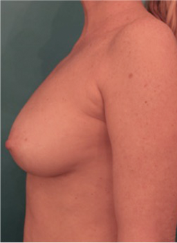 Breast Augmentation (Fat) Patient #1 After Photo Thumbnail # 6