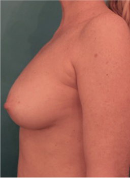 Breast Augmentation (Fat) Patient #1 After Photo # 6