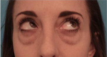 Lower Eyelid Blepharoplasty Patient #2 Before Photo # 7