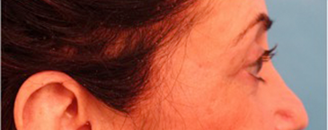 Lower Eyelid Blepharoplasty Patient #4 Before Photo # 5
