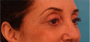 Lower Eyelid Blepharoplasty Patient #4 Before Photo # 3