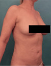 Liposuction Patient #21 After Photo Thumbnail # 16