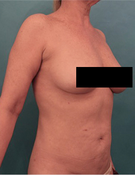 Liposuction Patient #21 After Photo # 16