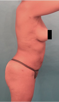 Brazilian Butt Lift Patient #6 After Photo # 4