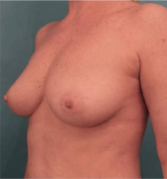 Breast Augmentation (Fat) Patient #1 After Photo Thumbnail # 4