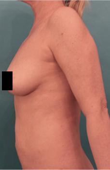Liposuction Patient #21 After Photo # 6