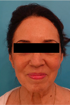 Facelift Patient