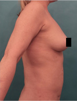 Liposuction Patient #21 After Photo # 14