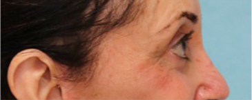 Lower Eyelid Blepharoplasty Patient #4 After Photo Thumbnail # 6