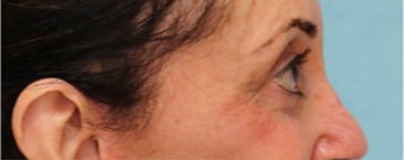 Lower Eyelid Blepharoplasty Patient #4 After Photo # 6