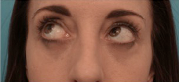 After Image: Lower Eyelid Blepharoplasty Patient #2 - 