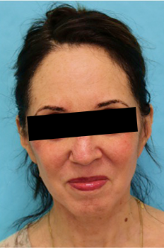 Facelift Patient