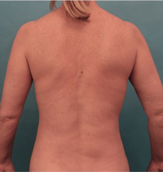 Liposuction Patient #21 After Photo # 10