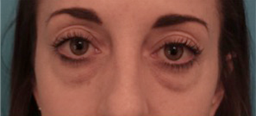Lower Eyelid Blepharoplasty Patient #2 Before Photo Thumbnail # 1