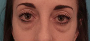 Before Image: Lower Eyelid Blepharoplasty Patient #2