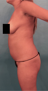 Brazilian Butt Lift Patient #6 Before Photo # 1