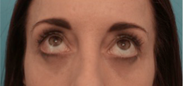 After Image: Lower Eyelid Blepharoplasty Patient #2 - 