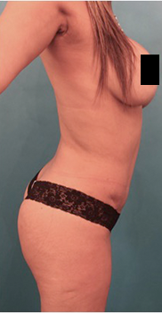 Brazilian Butt Lift Patient #5 After Photo Thumbnail # 8