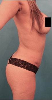 Brazilian Butt Lift Patient #5 After Photo # 8