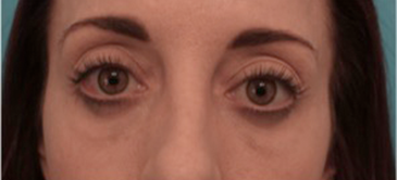 Lower Eyelid Blepharoplasty Patient #2 After Photo # 2
