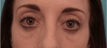 After Image: Lower Eyelid Blepharoplasty Patient #2